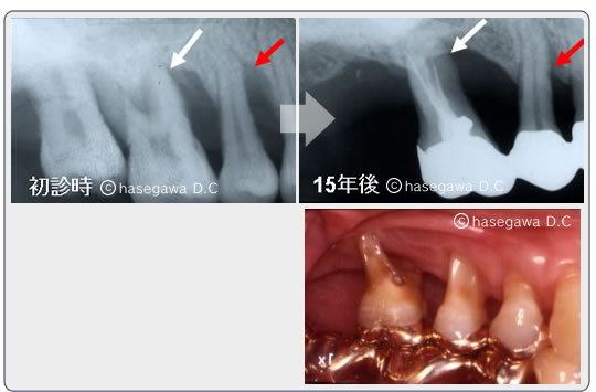 歯周病治療