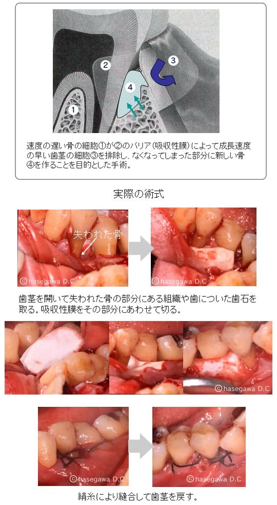 歯周組織再生療法